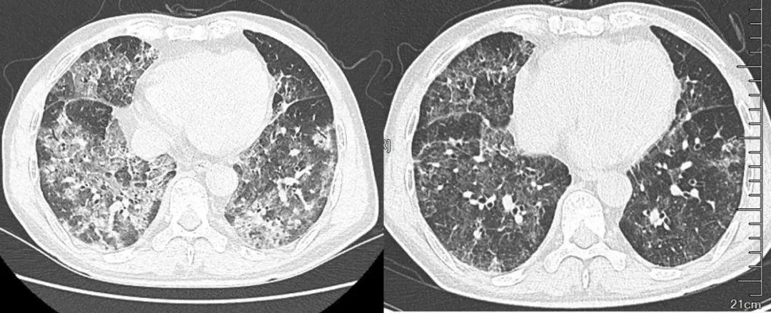 南京新冠肺炎最新通报，疫情防控形势及应对策略概述