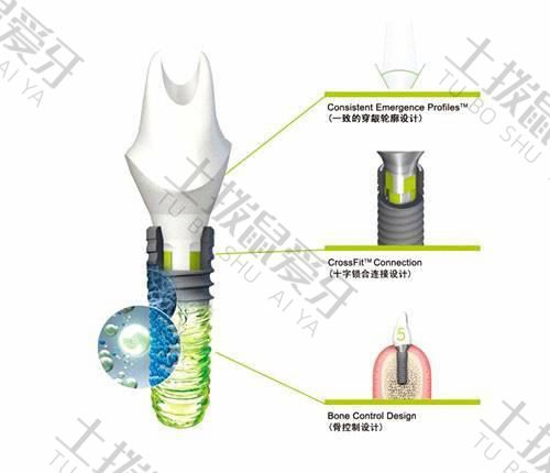奥地利最新款植入体,医疗科技革新先锋